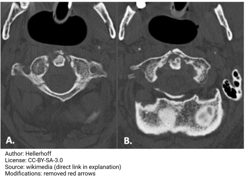 Jefferson burst fracture